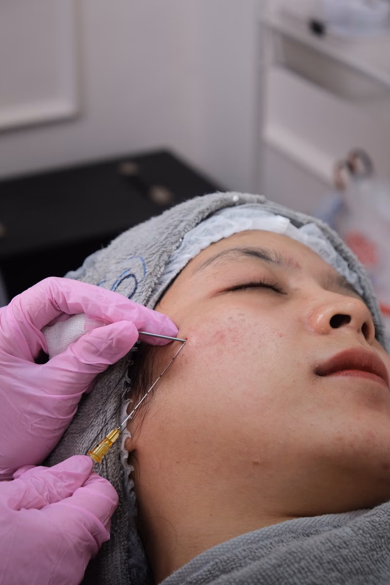 PRP vs PRGF vs Exosomes for hair loss in Multan - Elixir Aesthetics